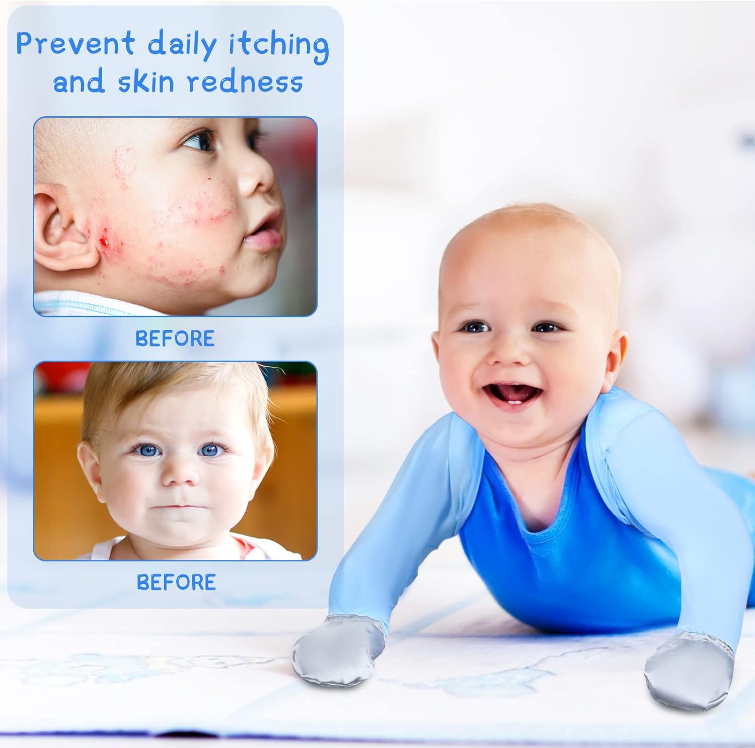 Sureio Baby Eczema Mitten Gloves 2-Piece Set for Toddler